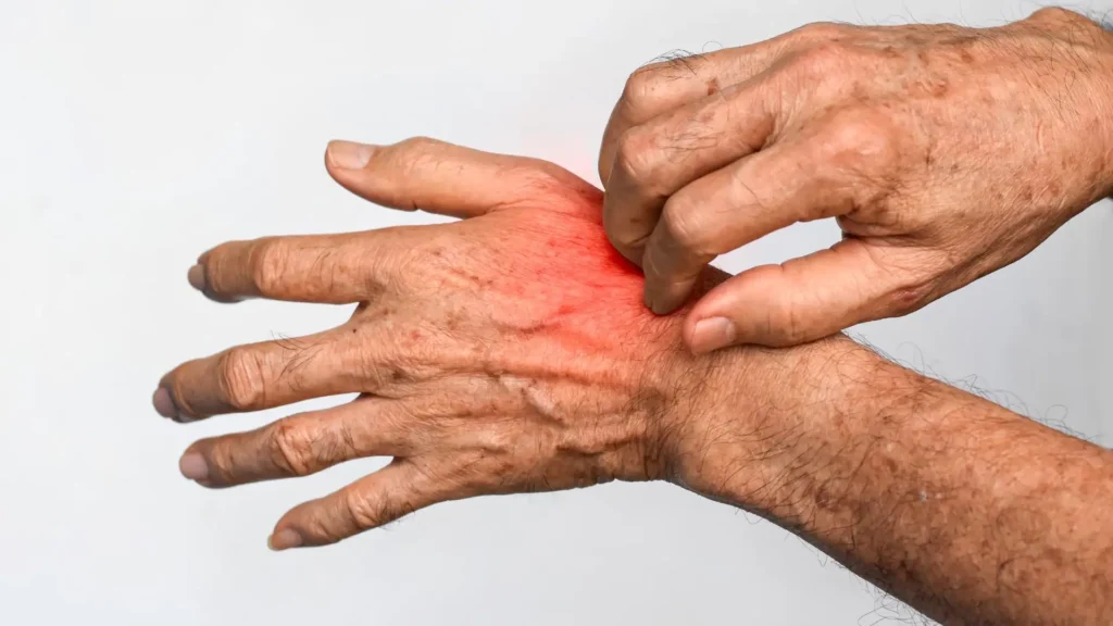 Psoriatic Arthritis and Balance Problems