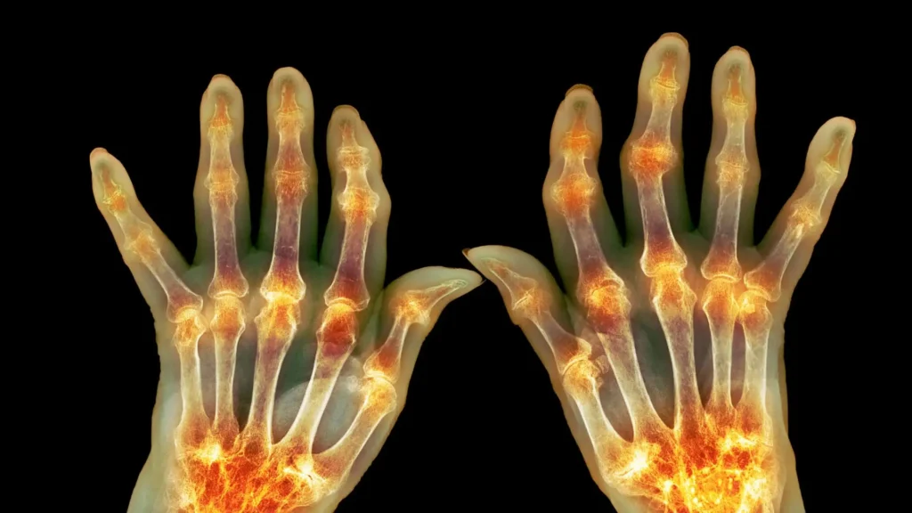 Early Signs of Arthritis Most People Ignore