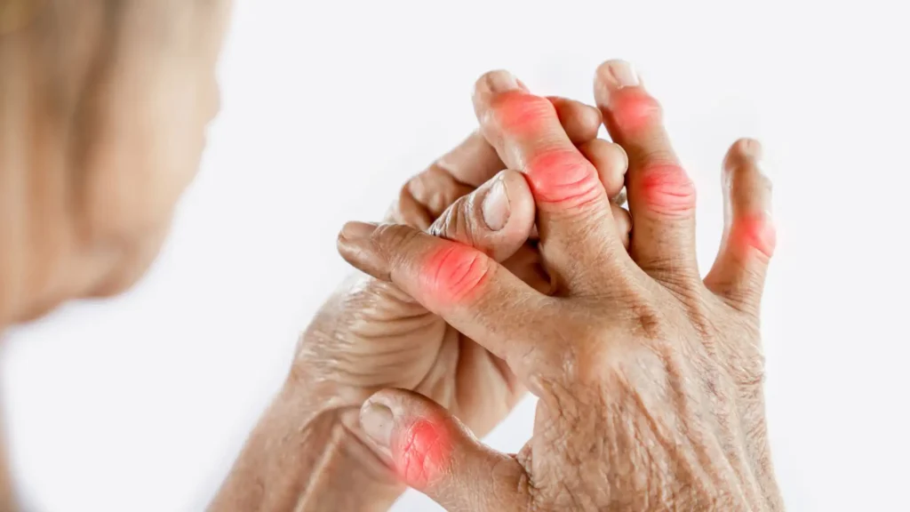Exercises That Relieve Arthritis in Fingers