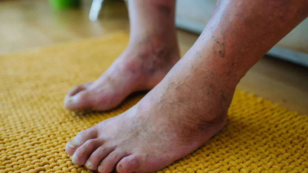 Reactive Arthritis