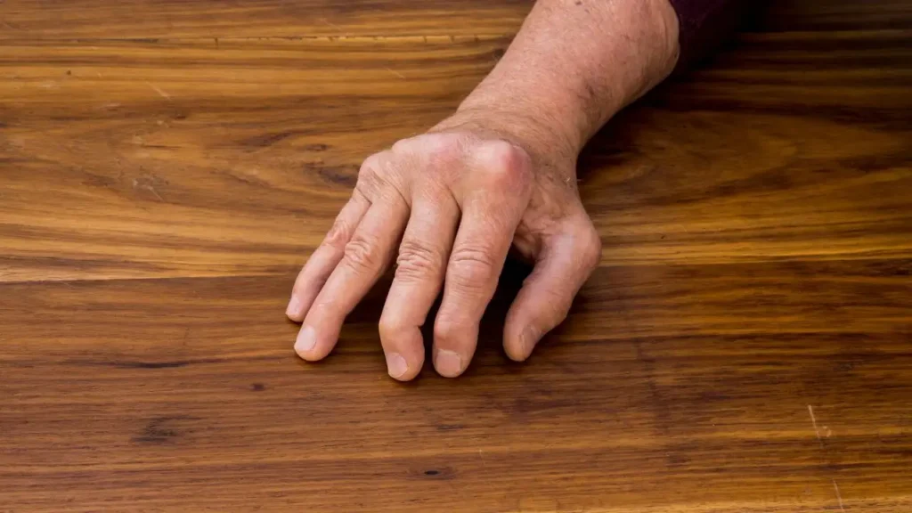 Psoriatic Arthritis Nail Changes