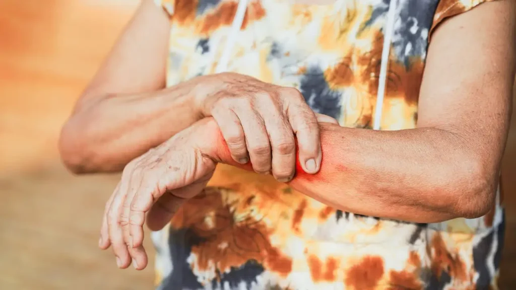 The Connection Between Arthritis and Lupus