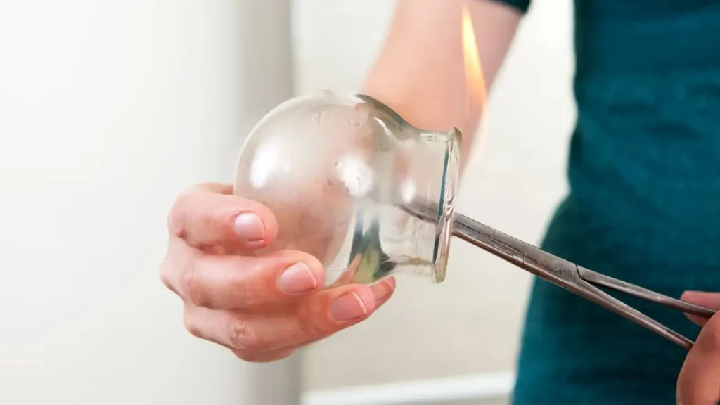Cupping Therapy for Arthritic Knees
